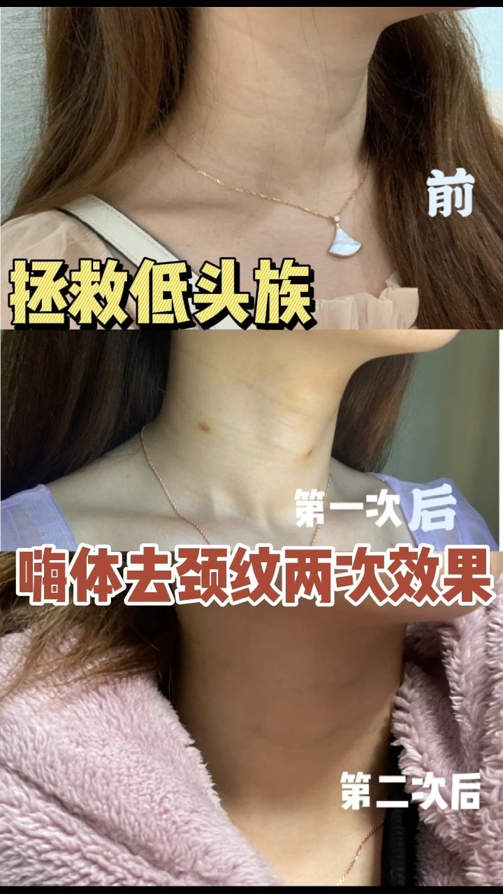 嗨体去颈纹两次效果对比来了,自己感觉现在脖子都光滑了很多,而且嫩嫩