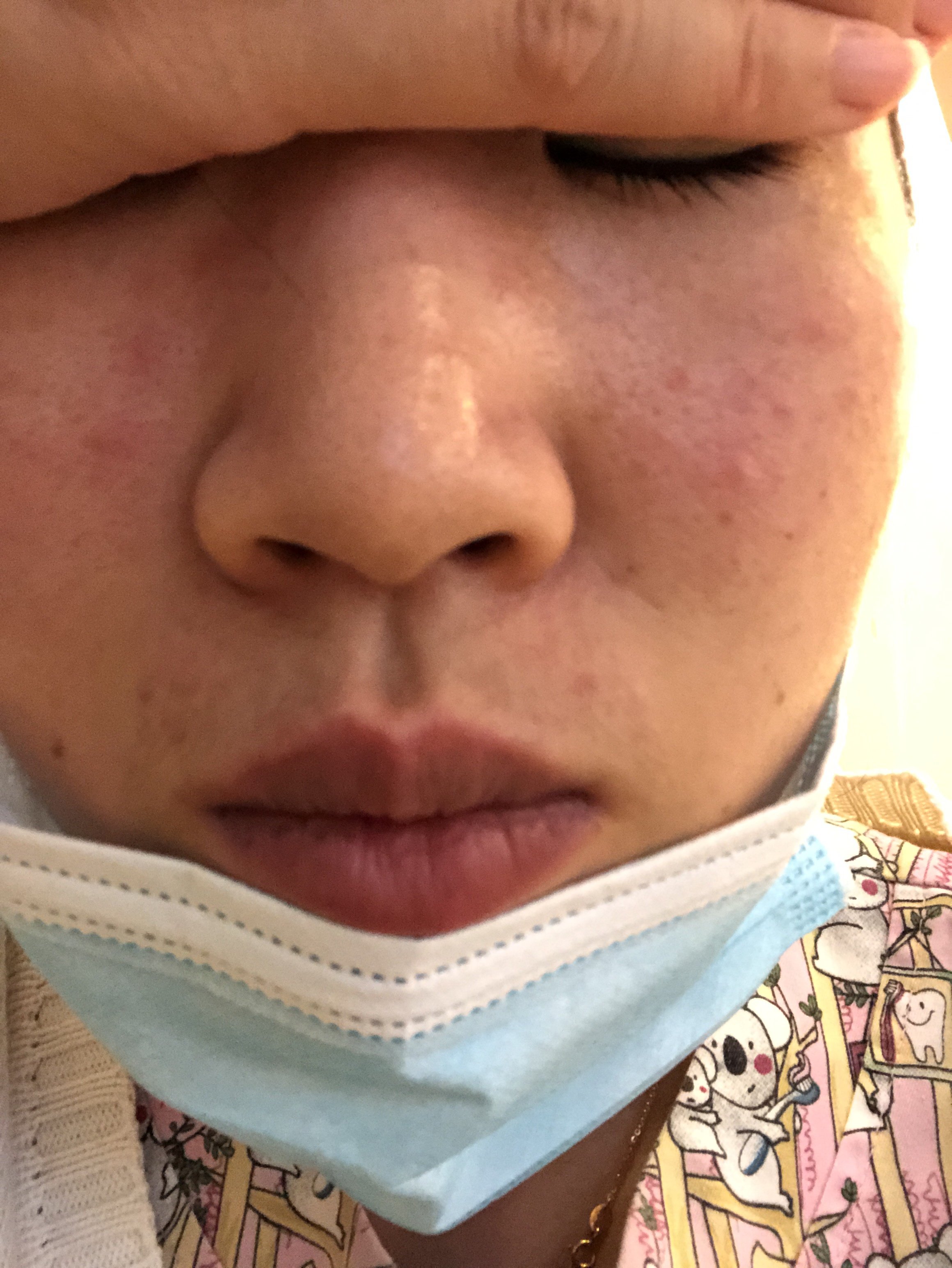 不知道是否消毒剂的原因过敏了