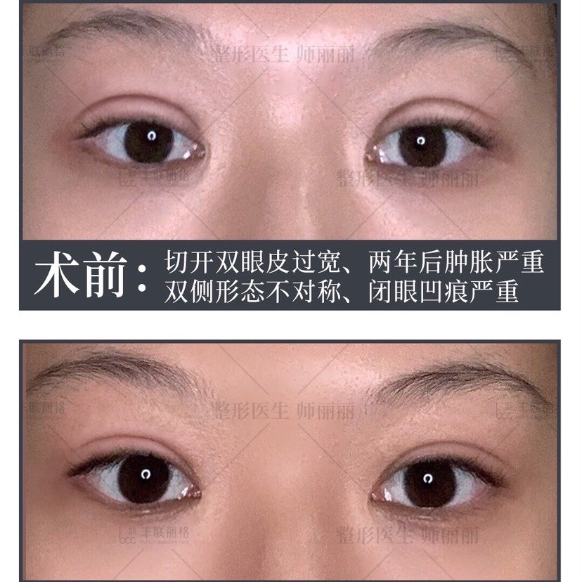 修复过两次的双眼皮还能再修复吗 新氧美容整形