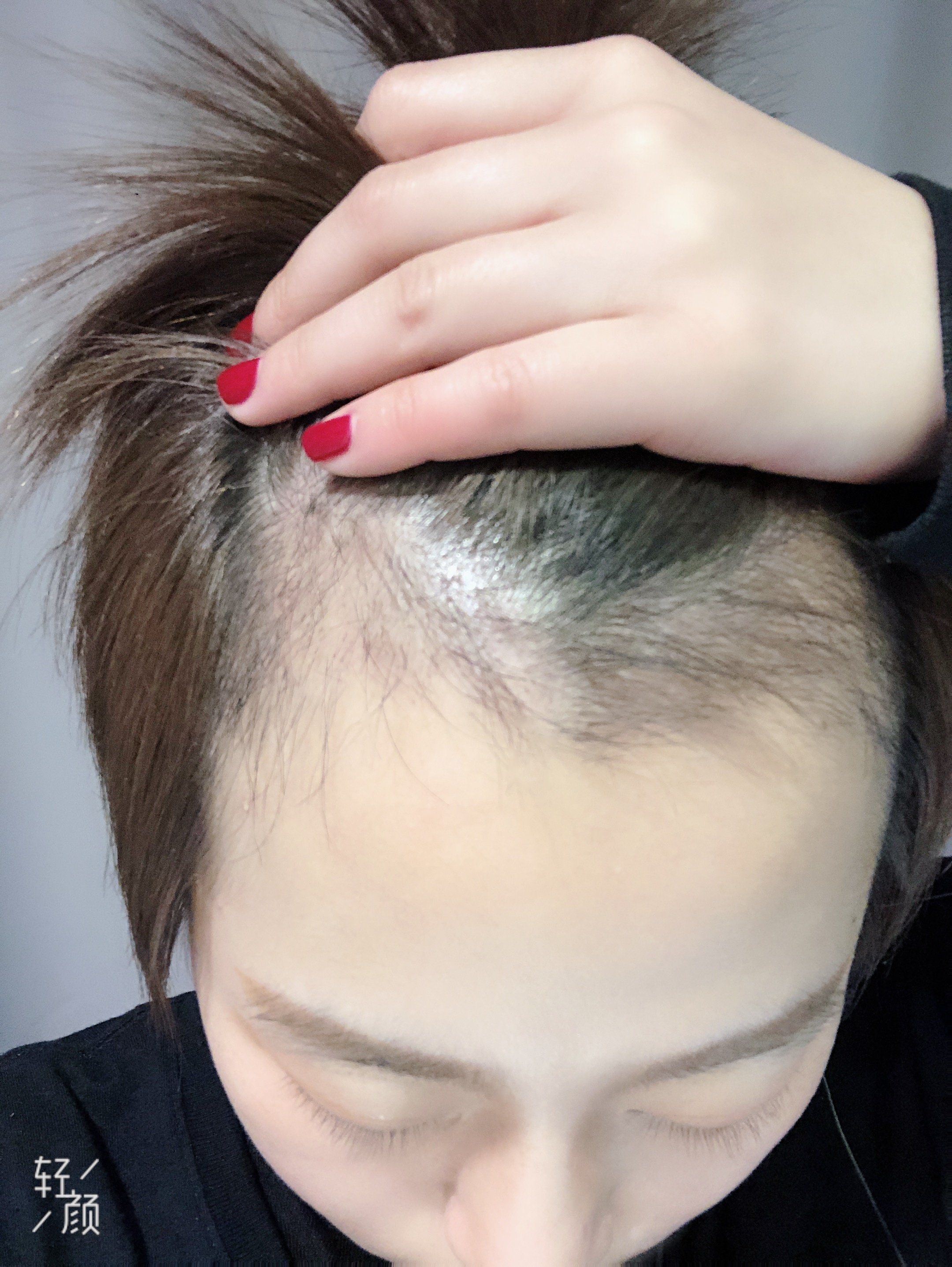 为什么孕期和产后会掉头发哺乳期可以植发吗