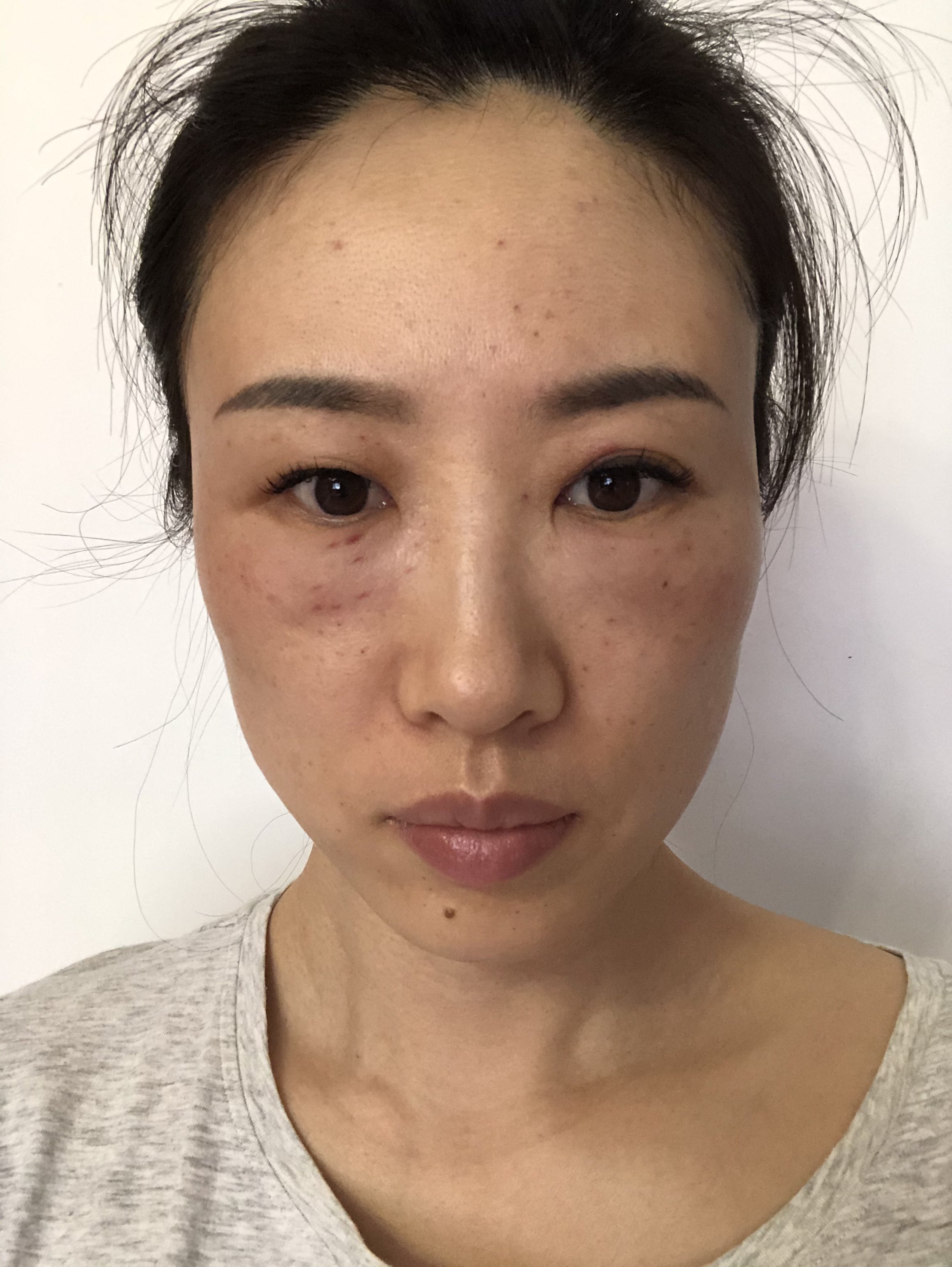 嗨体打眼周第三天还未消肿会不会有问题