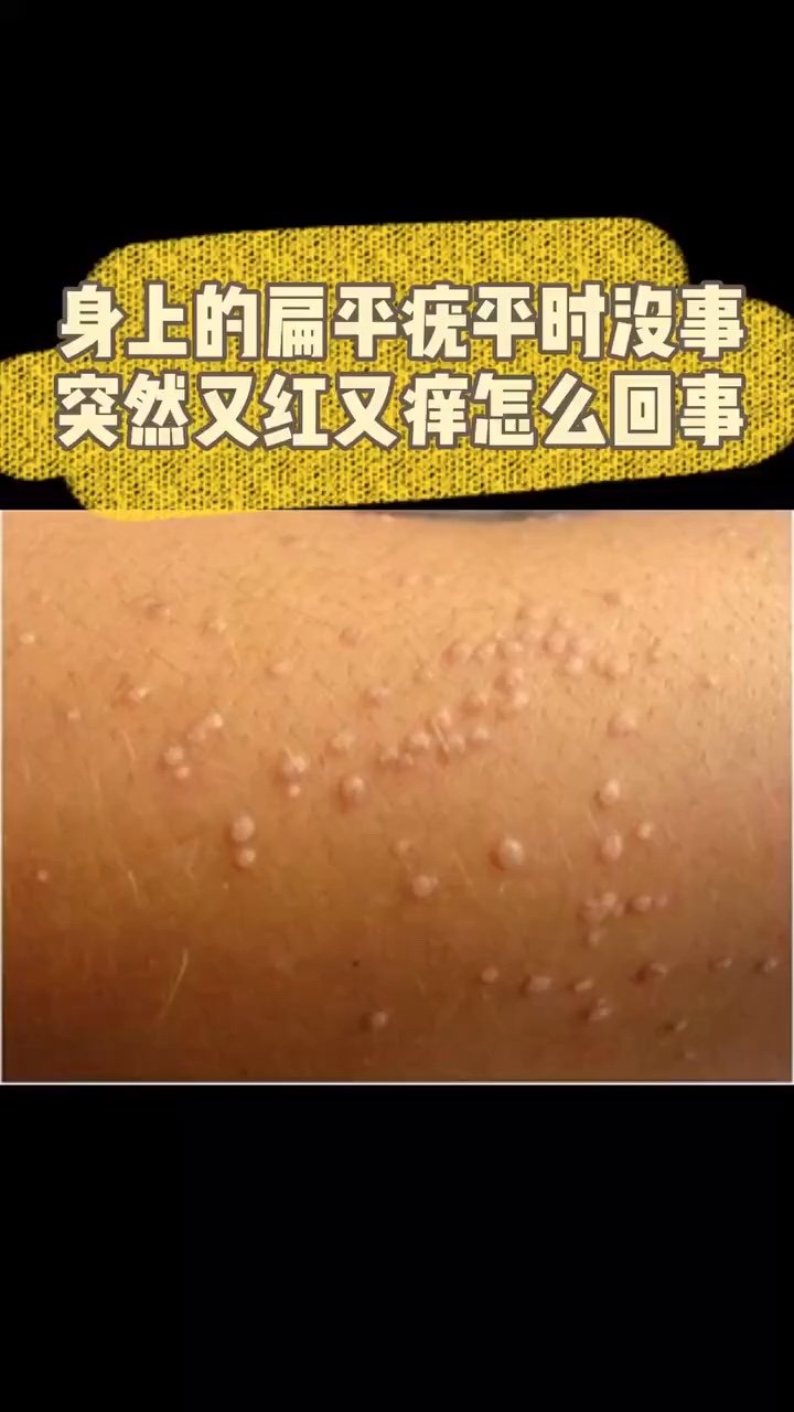 身上的扁平疣又红又痒怎么办?