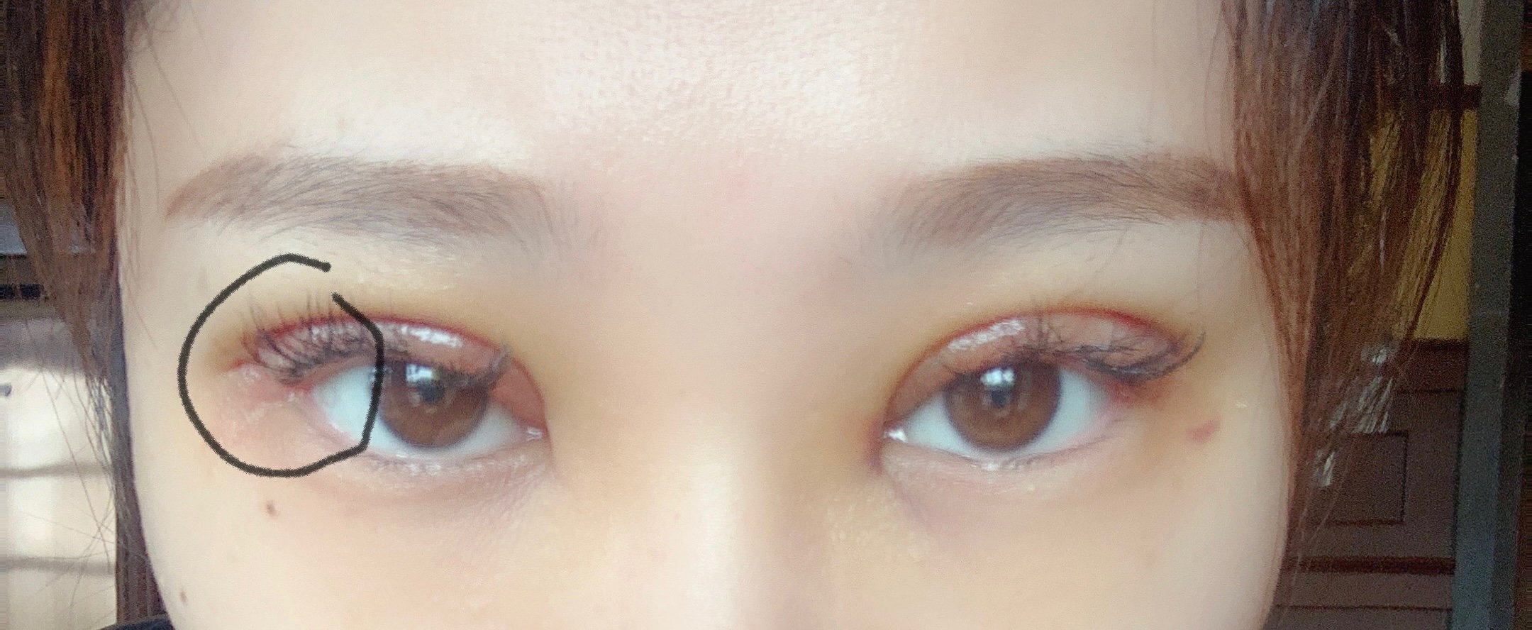 做完双眼皮四天了左眼眼角有点外翻是什么原因呢能恢复吗