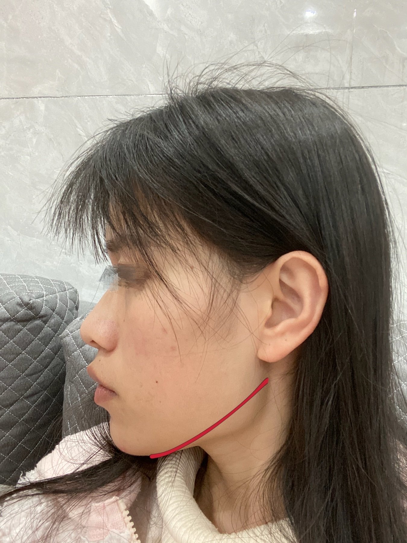 下颌骨长曲线削骨纠结