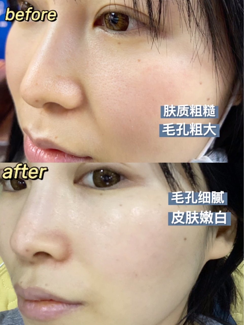 缩毛孔效果碾压光子嫩肤微针真实揭秘