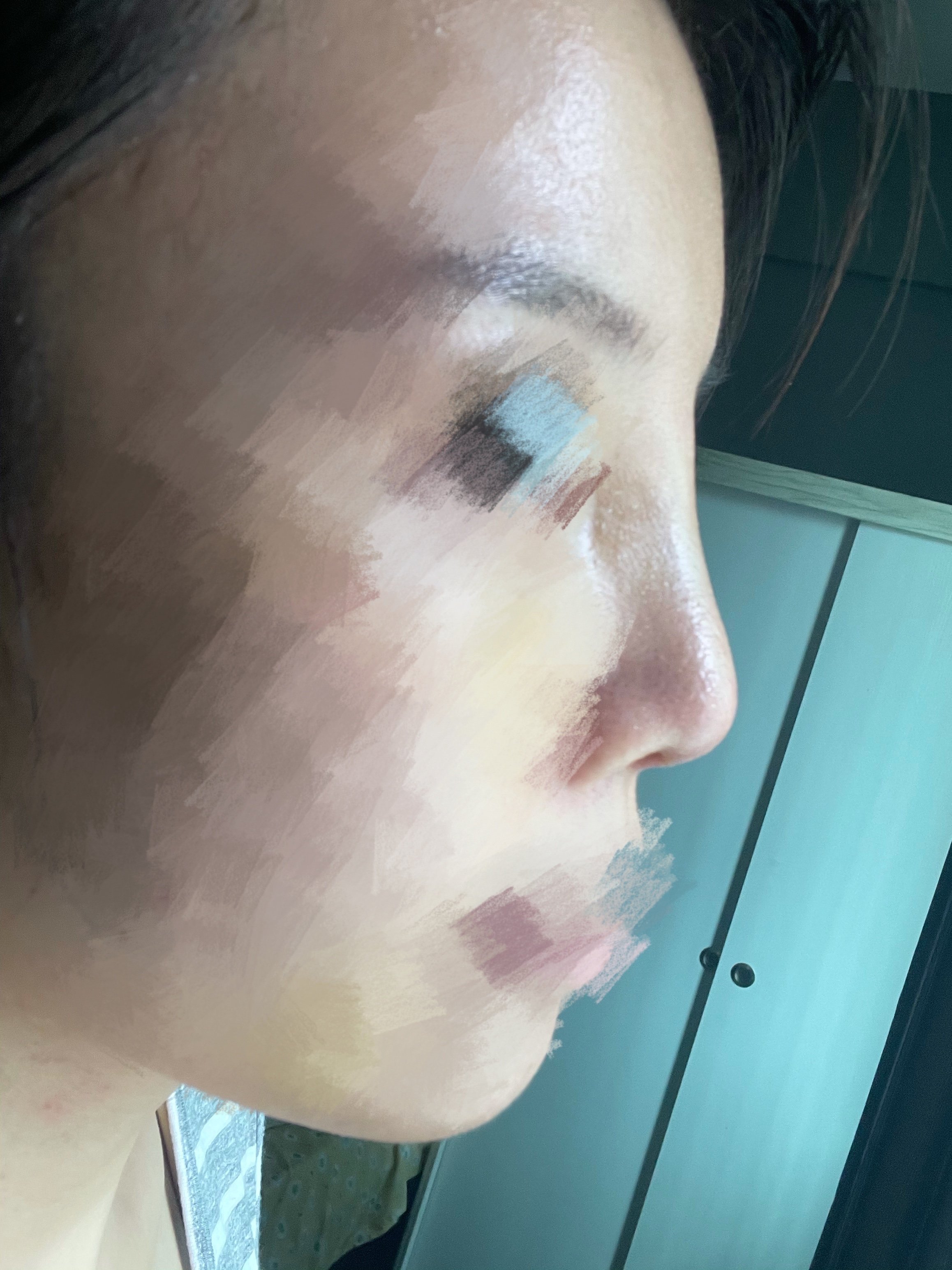 隆鼻天假体倾斜山根左侧鼓包求医生帮忙解答