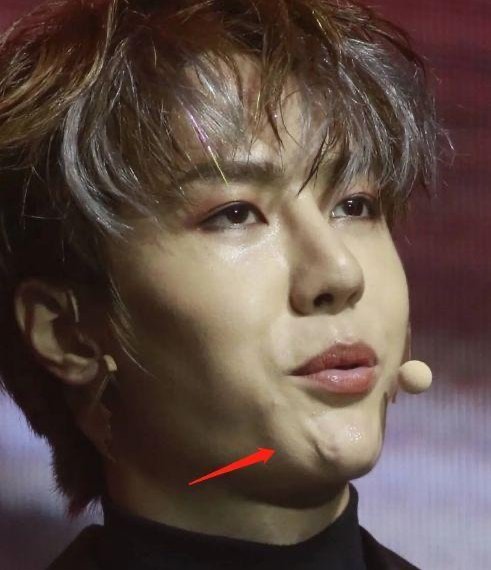 王一博 你的鼻子怎么疤痕如此严重