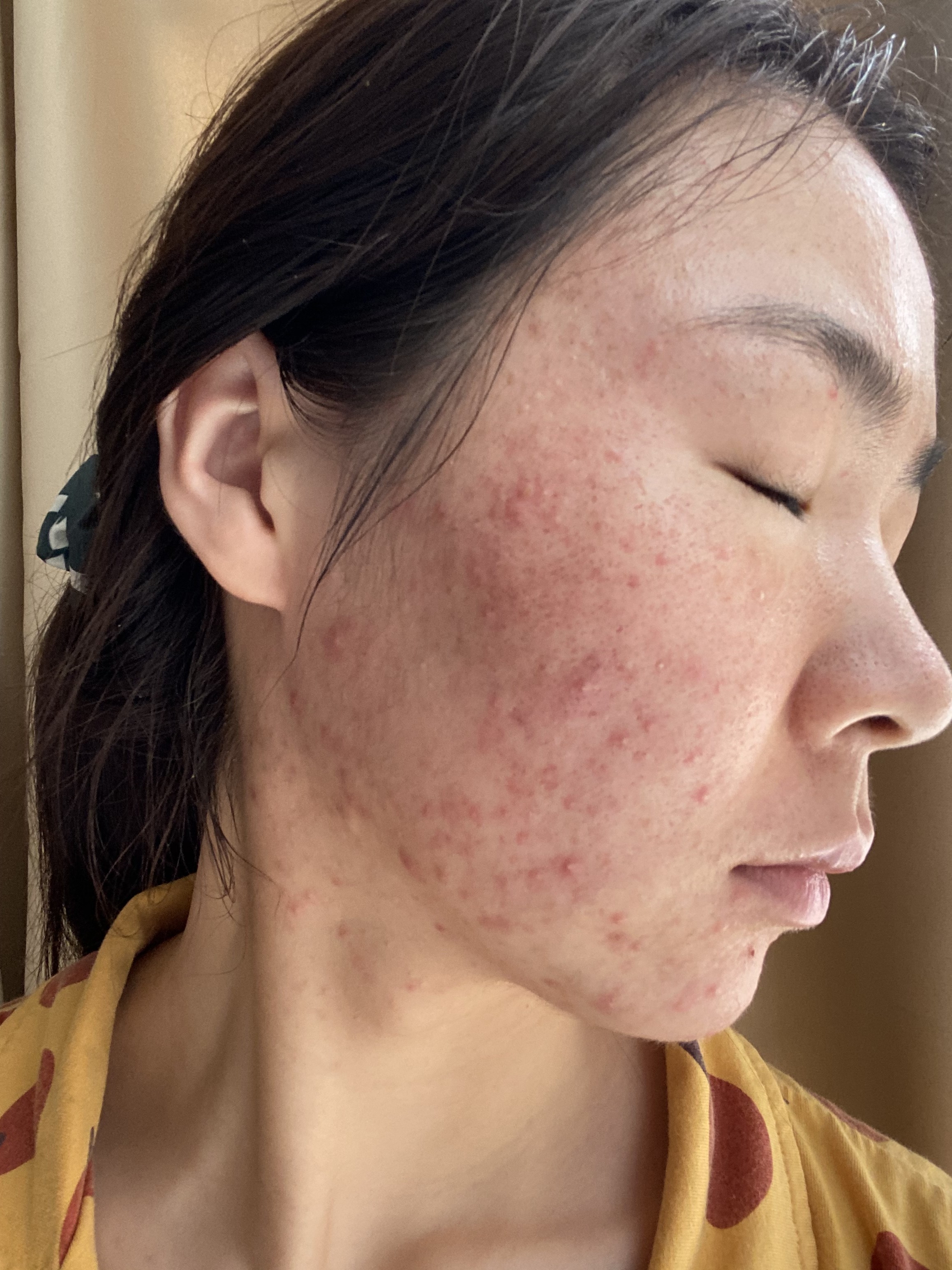 去痘印痘坑                    1          氧气b3pc6g