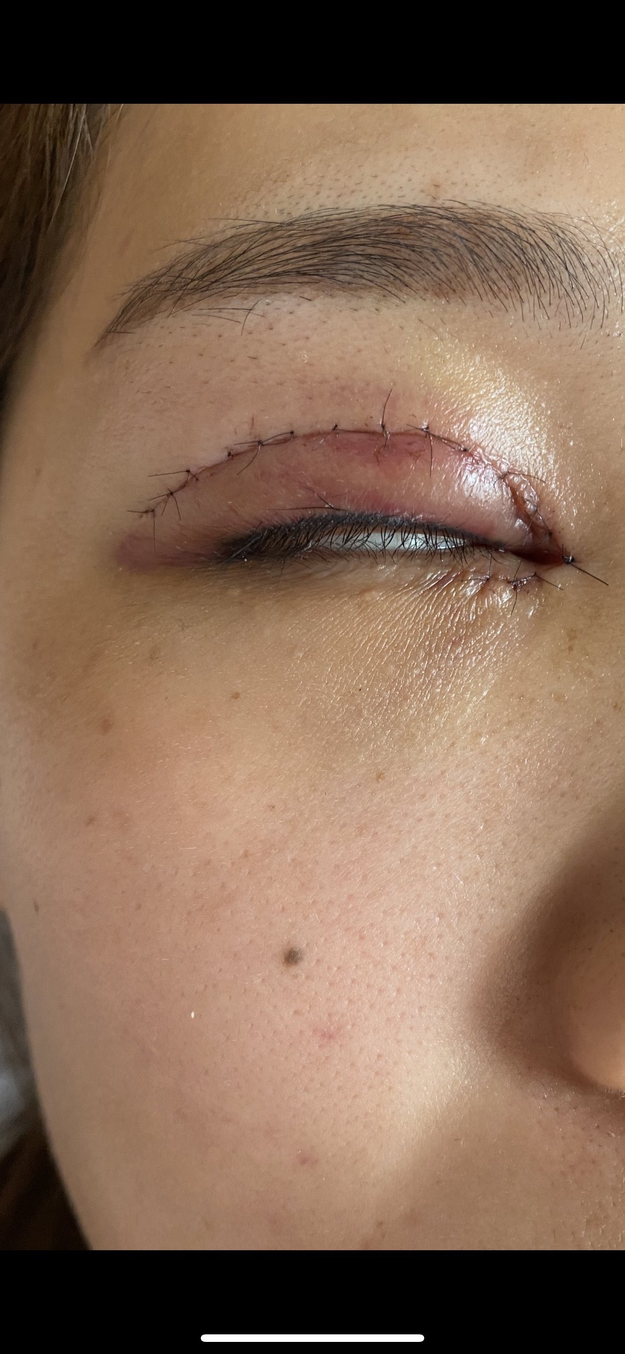 双眼皮术后请问那块小裂口需要处理吗