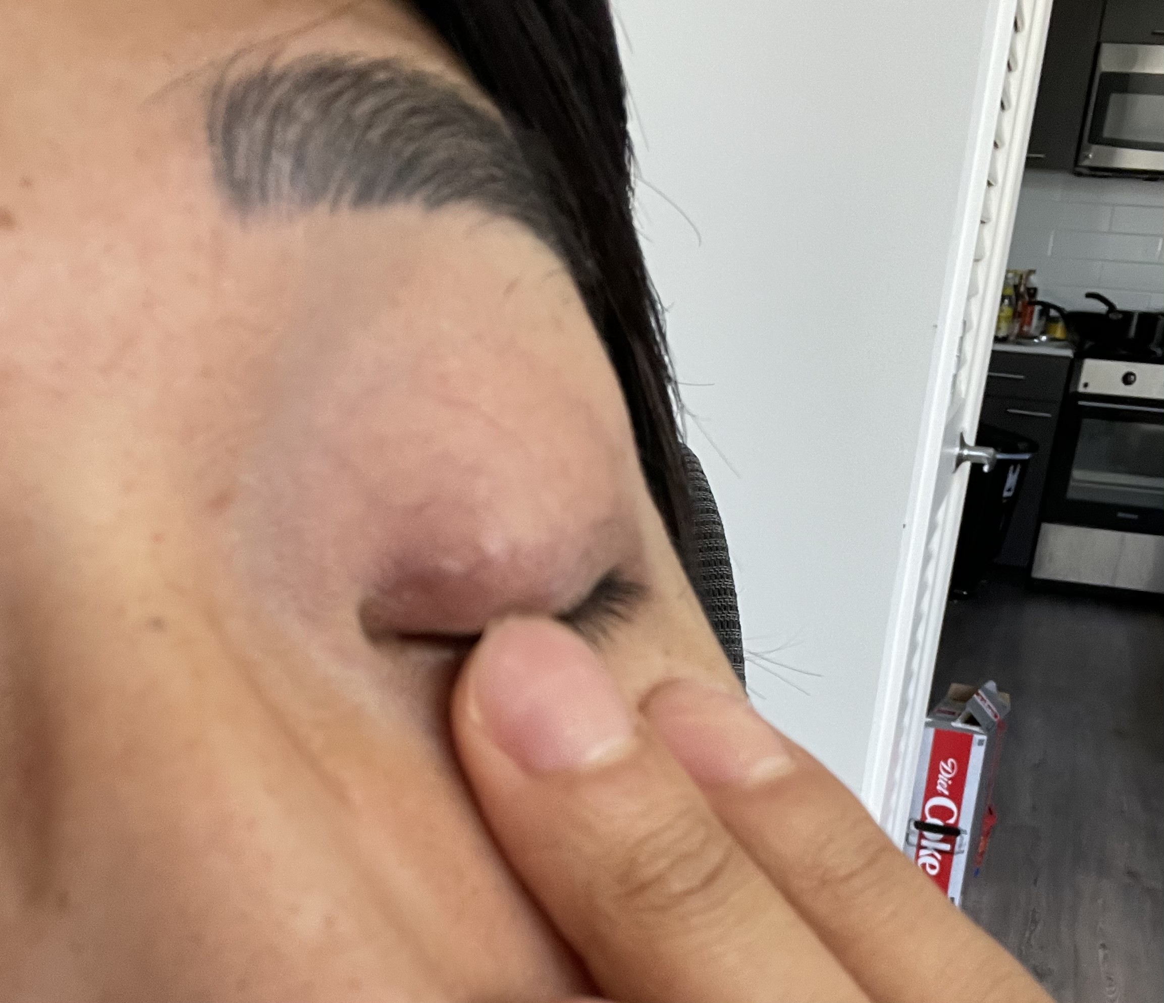 双眼皮埋线后眼皮有疙瘩结节