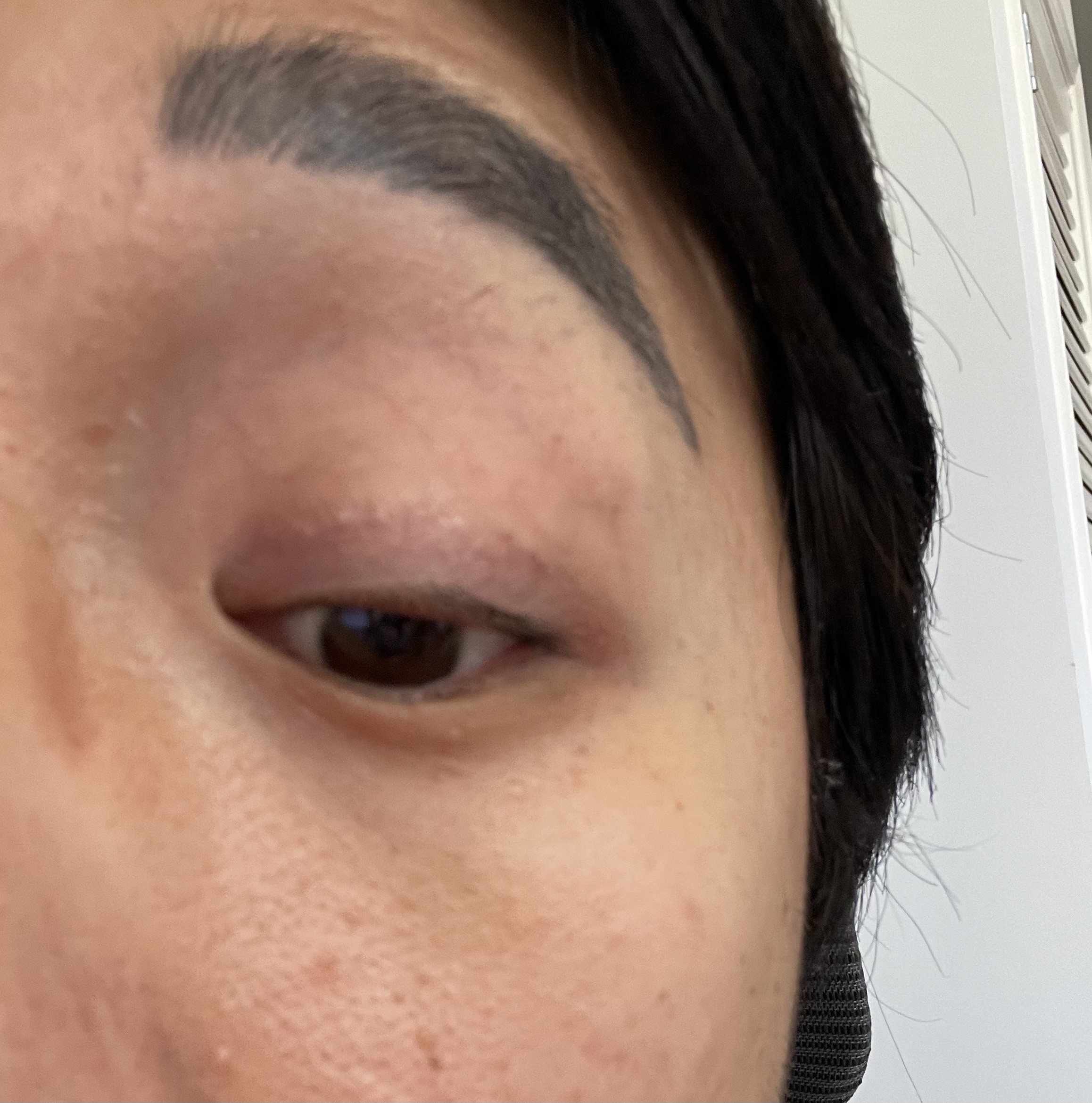 双眼皮埋线后眼皮有疙瘩结节