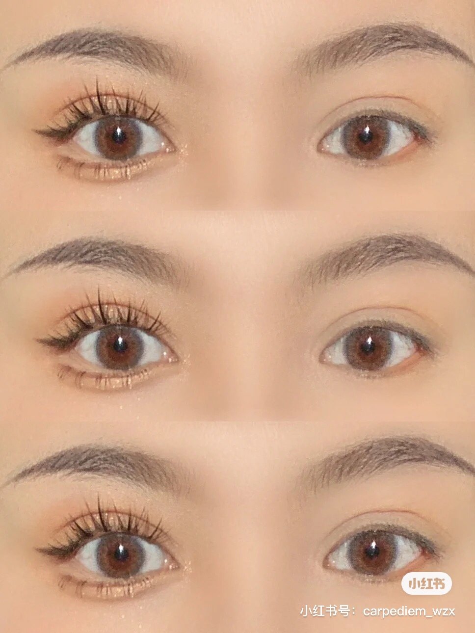 我的眼睛可以做平行双眼皮吗