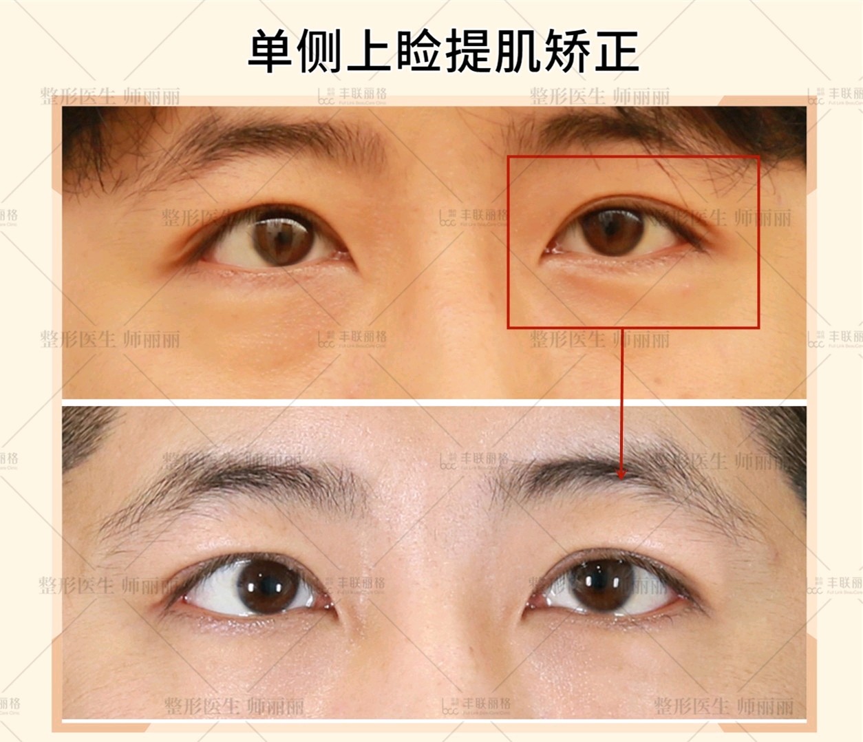 我眼睛是不是属于肌无力啊