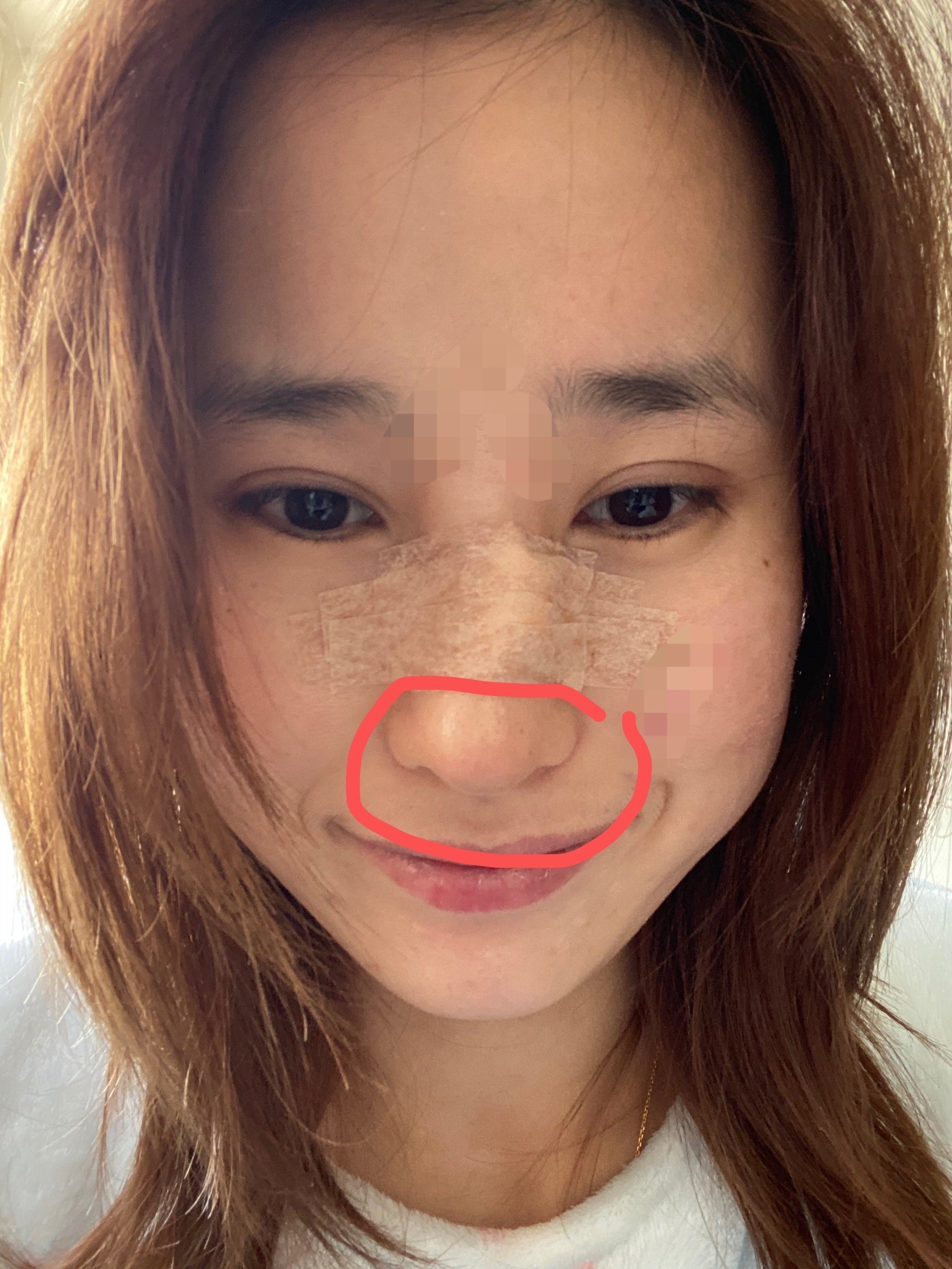 我肋骨鼻术后十一天,鼻尖下旋,尤其一笑妥妥的老巫婆_圈子-新氧美容