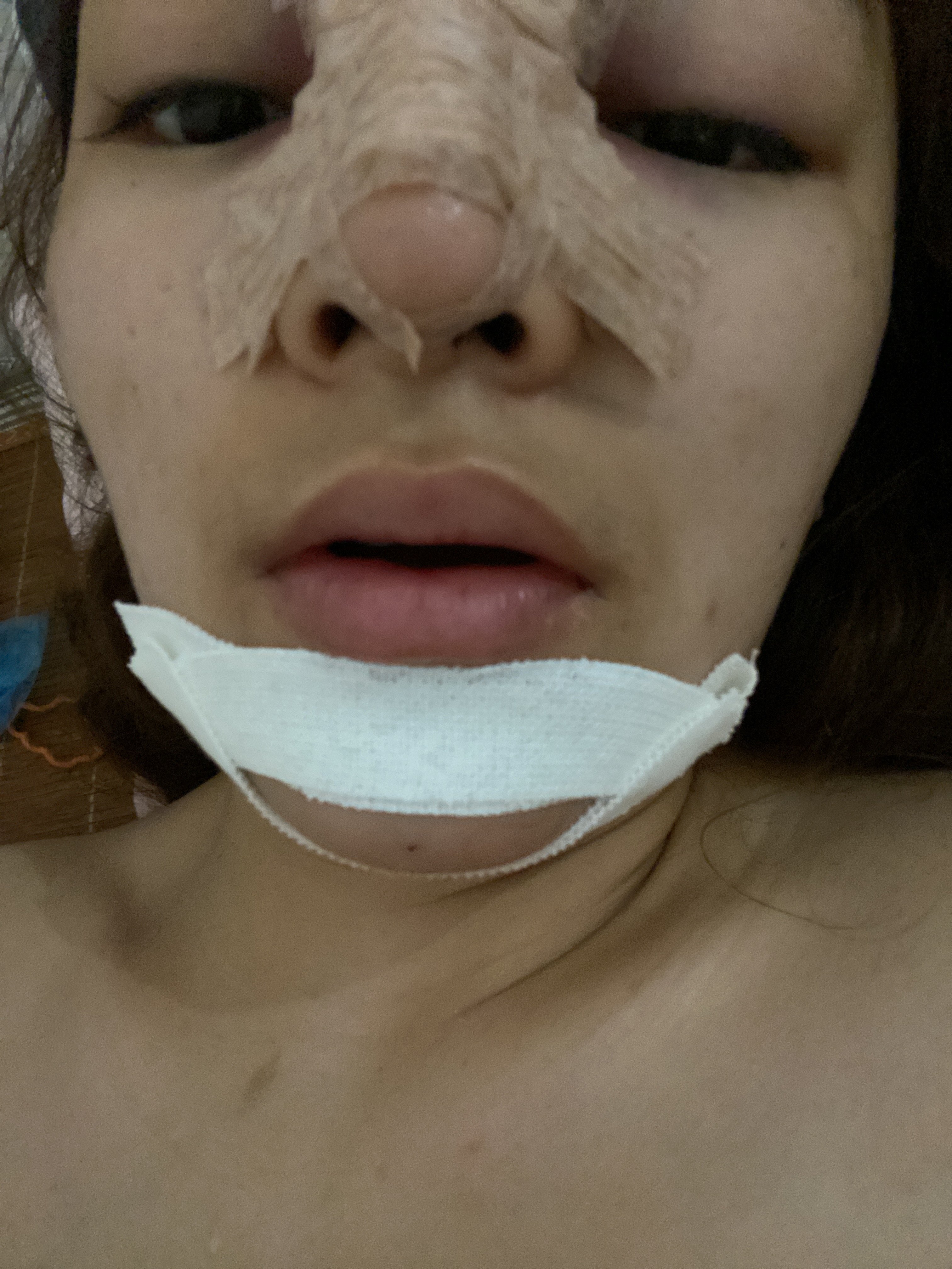 刚做完假体下巴疼得厉害可以吃止疼药吗 新氧美容整形