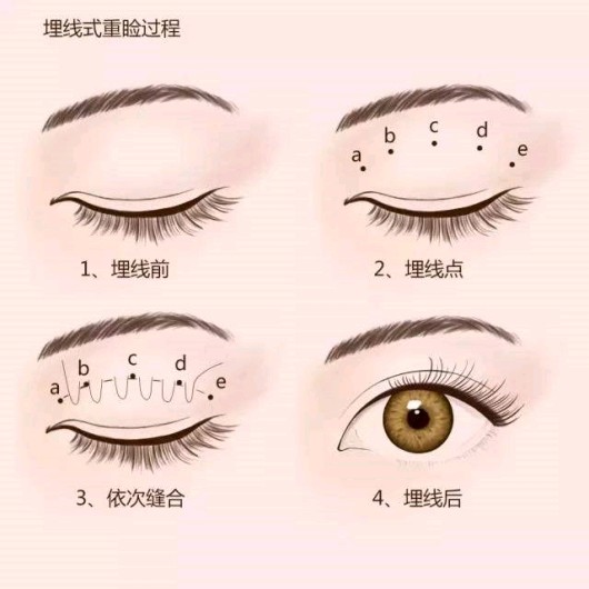 为什么眼部会长脂肪粒 新氧美容整形