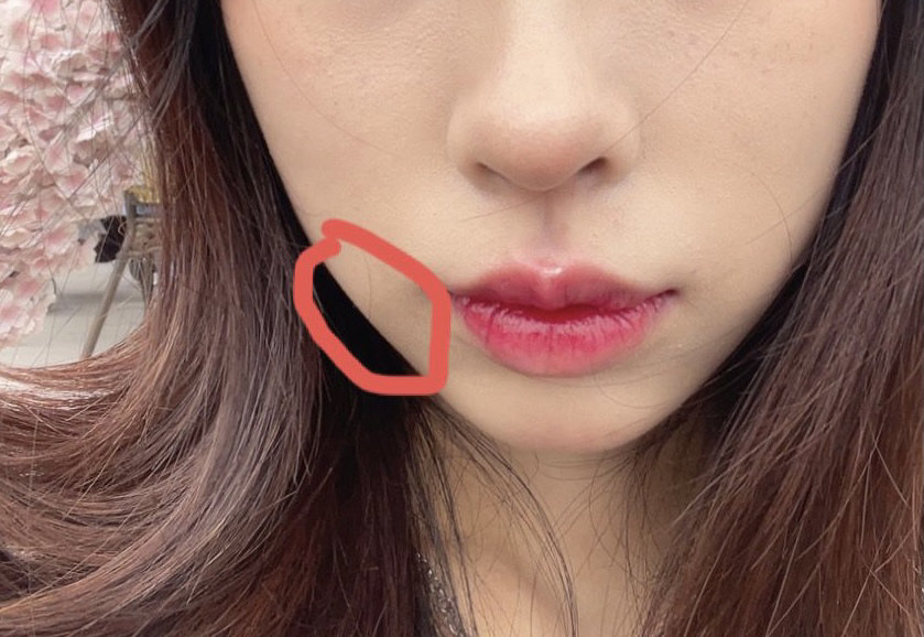 垫下巴半个月了经常感觉到左下颌角里的肌肉痛是正常的