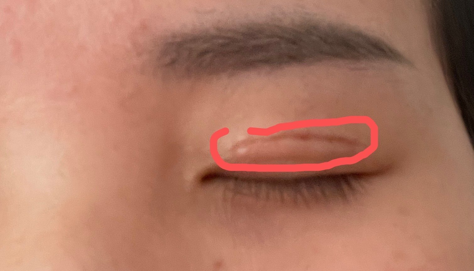 双眼皮第天小拆线后右眼刀口下方有一条鼓包