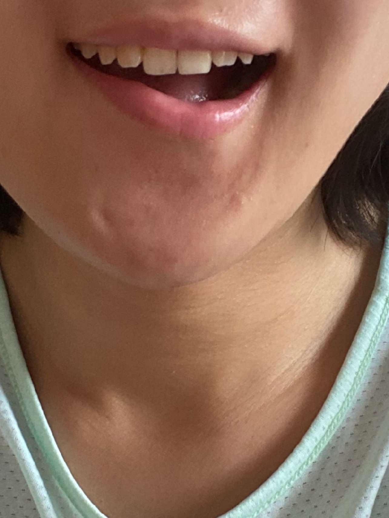 肉毒素瘦脸和下颌缘以后下嘴唇变歪请问是否可以恢复