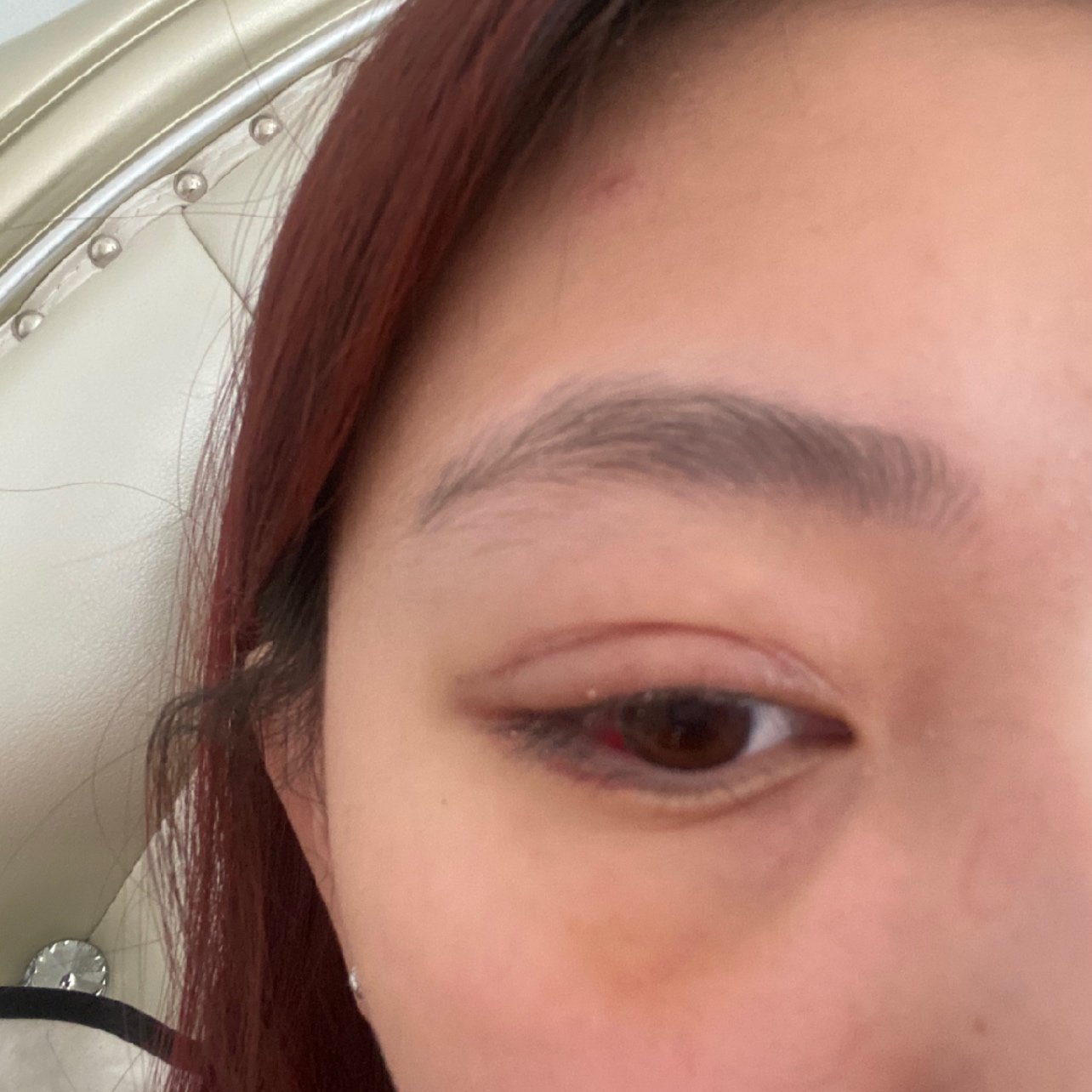 全切双眼皮修复分叉