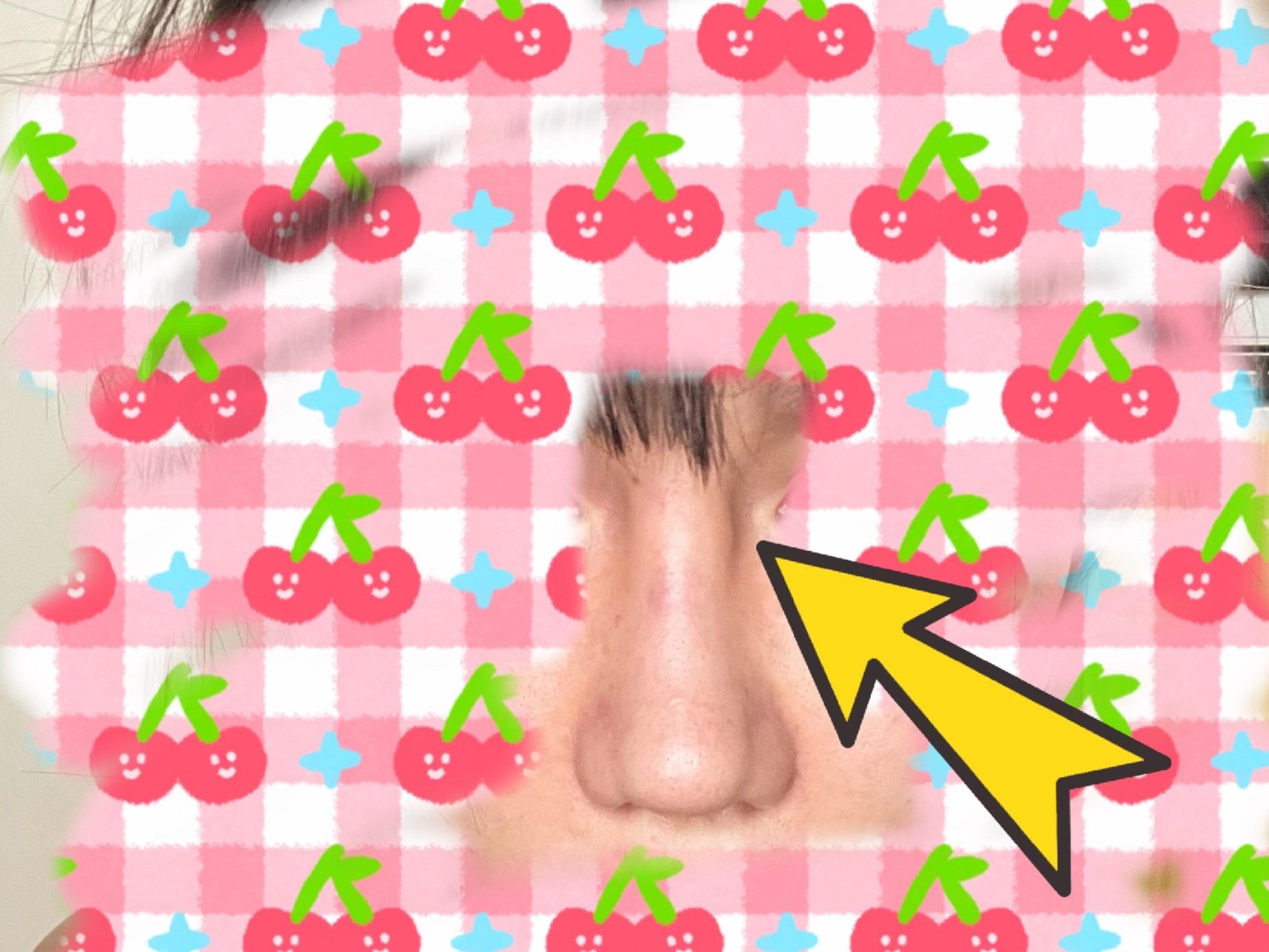 膨体隆鼻天鼻梁上的这个鼓包是什么