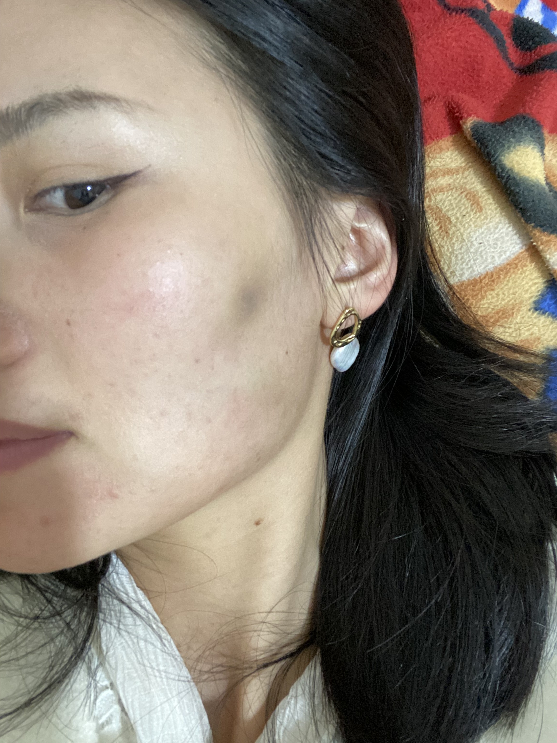 打完溶解酶巨凹陷哭死就一张松弛的皮