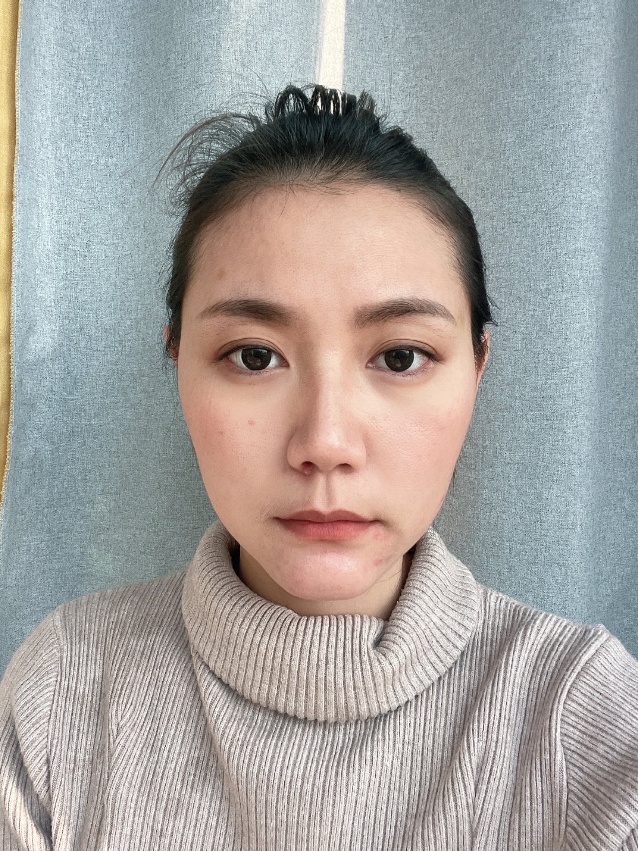 韩式生科下巴第20天,还是这么宽,很肥_新氧-专业医美服务平台