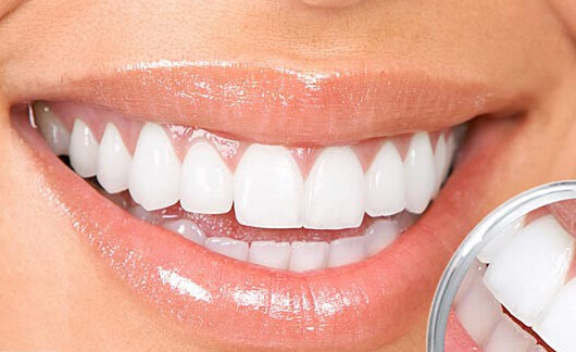 冷光牙齿美白 30分钟轻松搞定