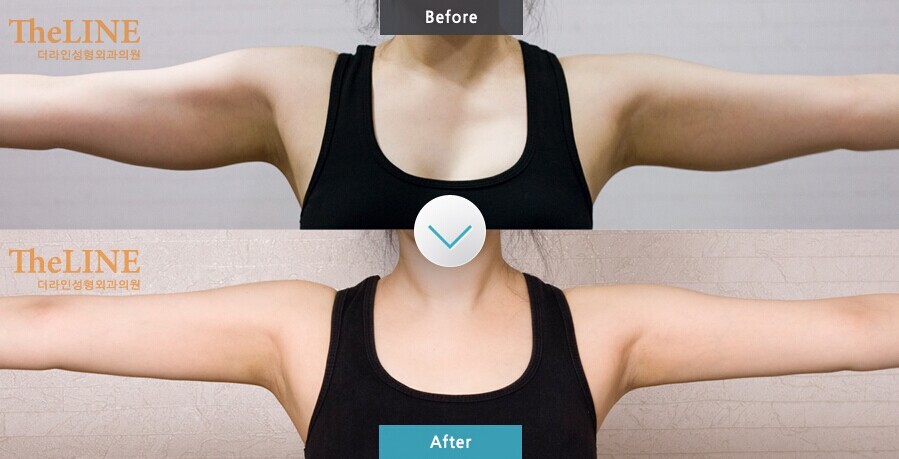 手臂皮下脂肪层诊断