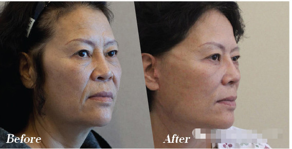韩国the整形外科面部提升术还给童颜的你随着时间人们的脸都会下垂