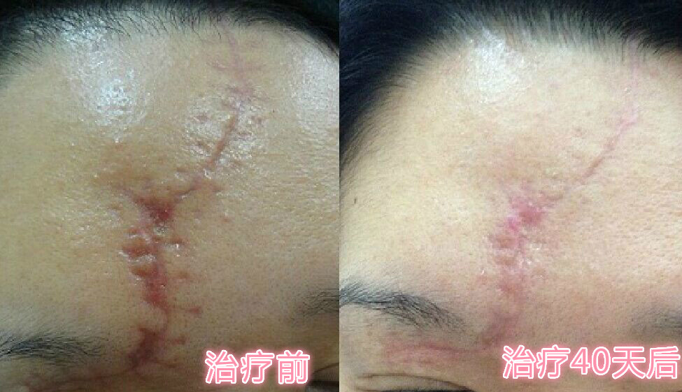 济南韩氏整形美容医院祛除疤痕术后一个多月,我脸上的这道疤痕,是今年