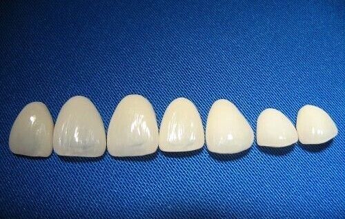 瓷贴面能维持多久?牙贴面就是在患者的牙齿表