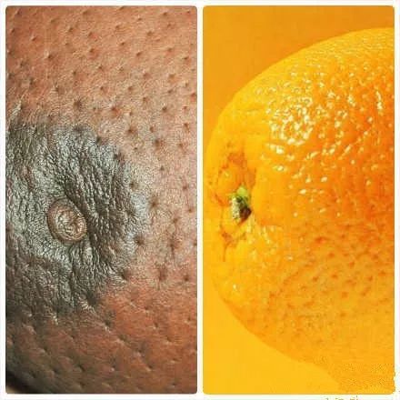 那么乳腺癌的常见临床表现有哪些呢?