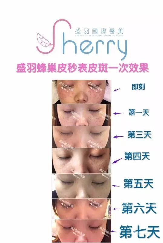 美国蜂巢皮秒为什么这么火?