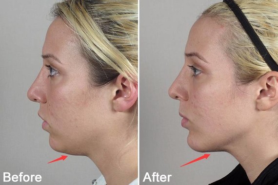 3,改善下巴短小后缩出现的双下巴.