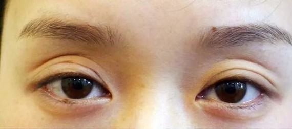 上眼睑凹陷,能做双眼皮吗?