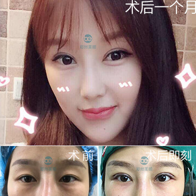 【切开双眼皮】【田氏翘睫综合双眼皮】:去皮去脂 眼尾提升 提肌无力