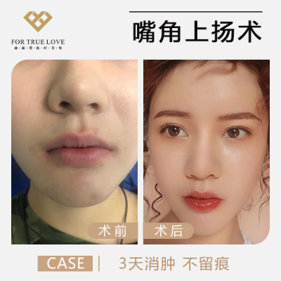 【嘴角上扬术】内切法/外切法 嘴角上扬 30度自然上 王皓民专家亲诊