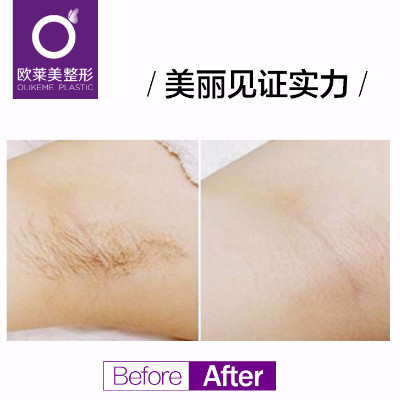 【激光脱毛】脱唇毛 一年12次 ,义乌冰点无痛脱毛,唇部/腋毛 1-12次