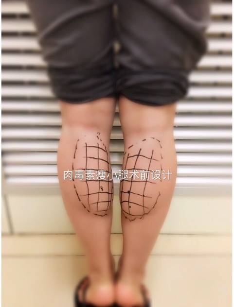 (划线,标记注射的点位)