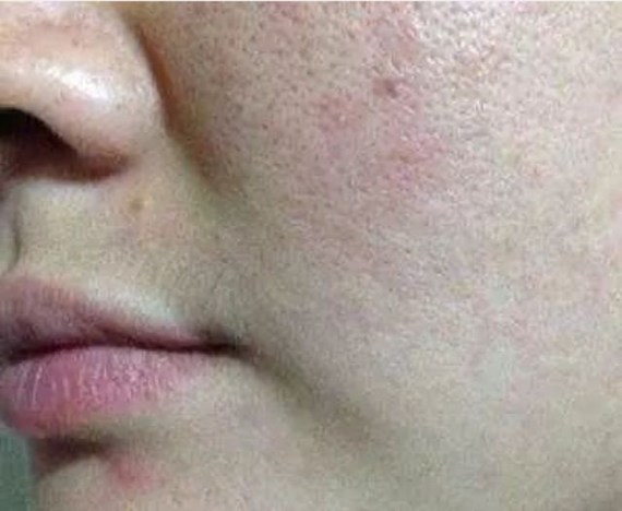 毛孔变得像火山石上的洞洞一样,更可怕的是还长了黑头.