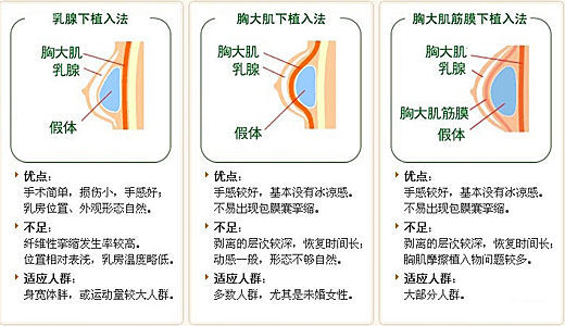 【科普课堂 】假体隆胸会影响以后的哺乳吗?