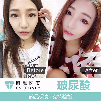 【玻尿酸】【双人同行送白瓷水光】 海薇玻尿酸1ml 立体塑形 美丽无