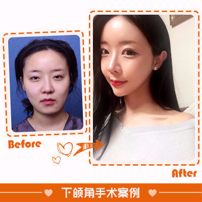 【下颌角整形】小面积剥离筋膜提升下颌角手术