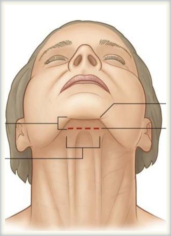 术前技术要点:颈部下颌缘轮廓欠清晰颏颈角变钝小颏畸形颏下脂肪堆积