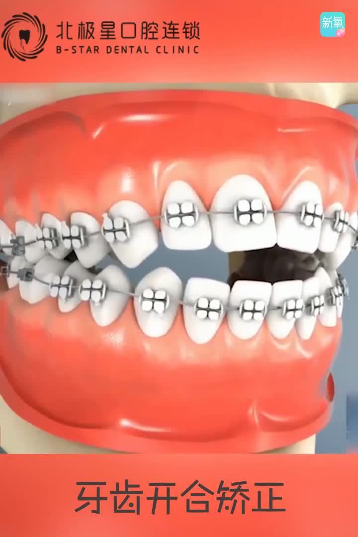 伙伴们看看牙齿开合矫正全过程