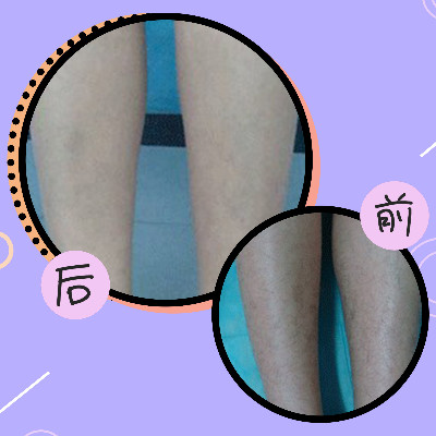 【激光脱毛】脱手脚毛 6次 ,【丽都品质冰点脱毛】四肢四选一 1年10次