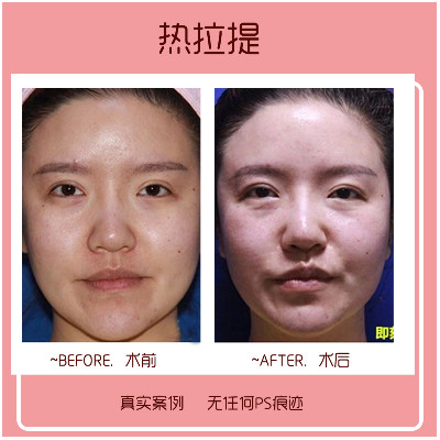 【热拉提】【紧致提升】进口以色列飞顿热拉提/安全无创立体提拉v脸