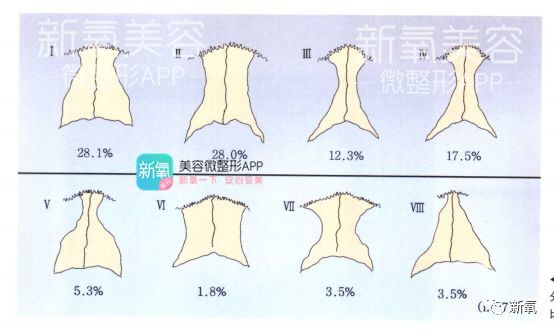 (大多数人鼻骨是,林心如更像是 林心如的