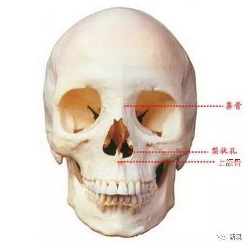 当上颌骨发育不良时,那和它是同一块骨头的梨状孔是不是也随之变凹了